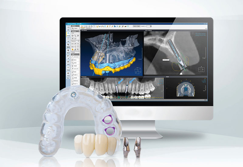 Implantologia Digitale Arcata Completa