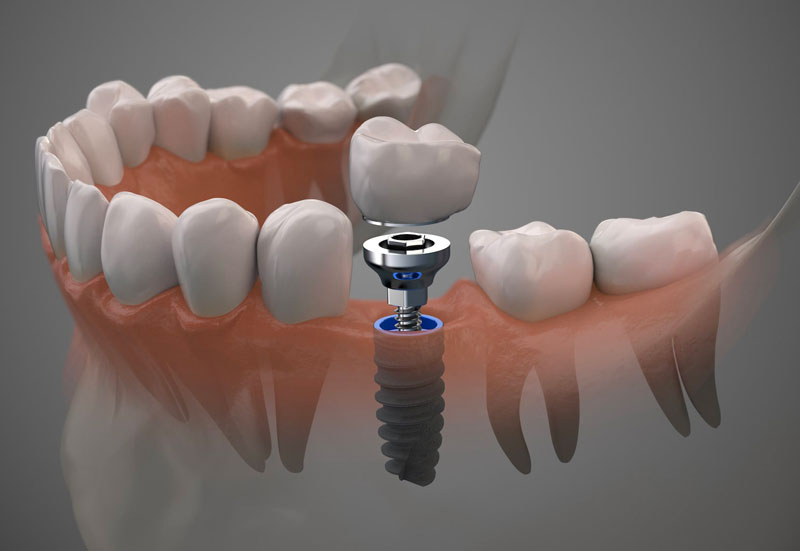 Implantologia Digitale Denti Singoli