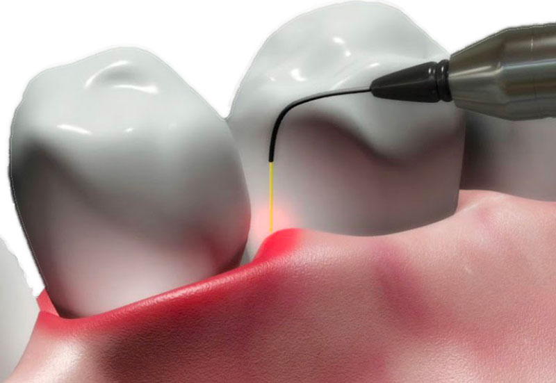 Parodontologia Laser